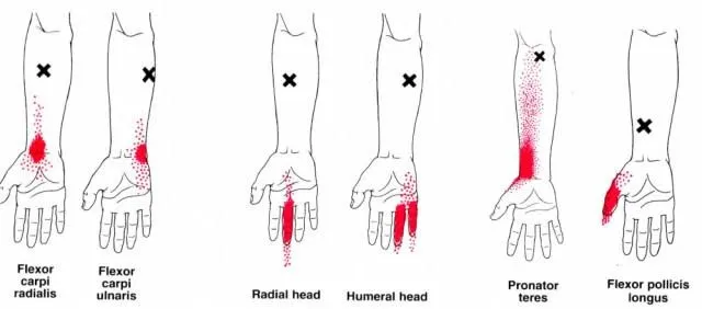 トリガーポイント施術での腱鞘炎の痛みの和らげ方